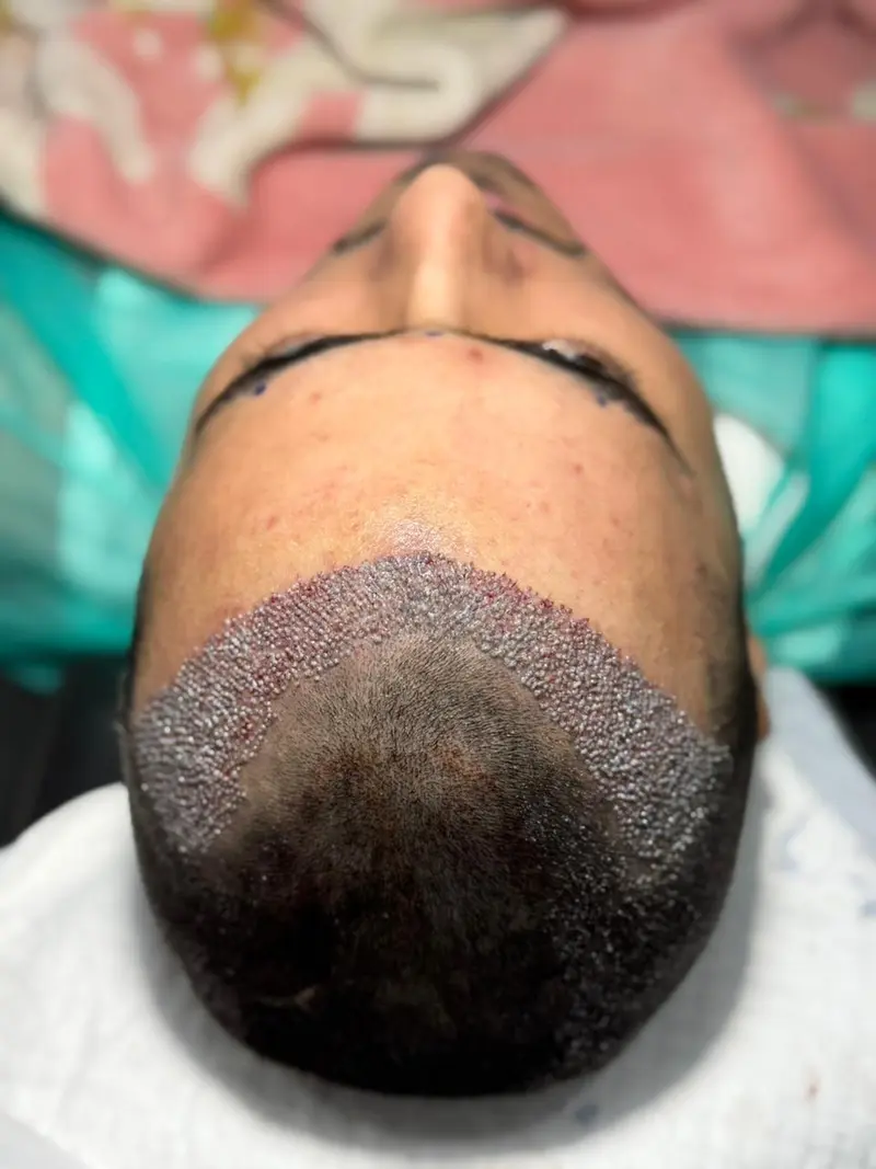 After FUE hair treatment — patient case case-fue-2800-norwood-v